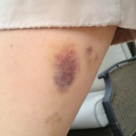 bruised thigh