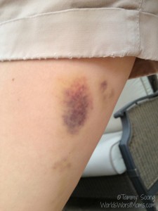 bruised thigh