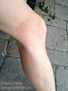 leg scar on woman